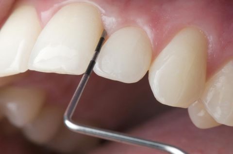 Parodontitisbehandlung